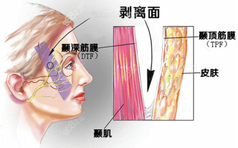 面部提升手术图示