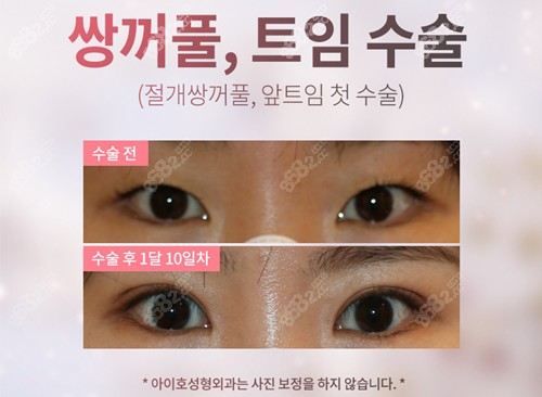 韩国爱护整形外科切开双眼皮手术