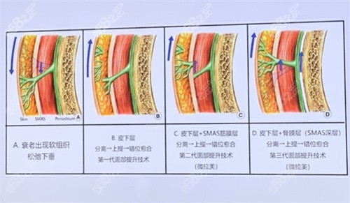 面部提升层次