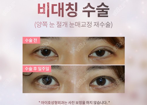 韩国爱护眼部提肌手术