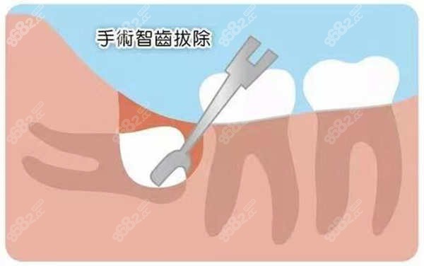 南京博韵口腔医院拔智齿多少钱一颗