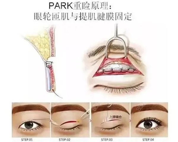 刘晋元医生做双眼皮手术的原理图