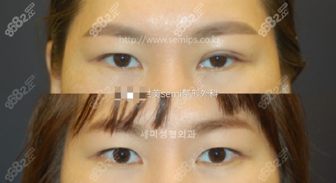 韩国世美整形双眼皮改单眼皮实例