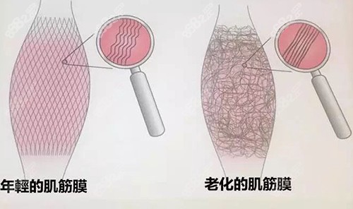 筋膜折叠术和筋膜悬吊哪个好