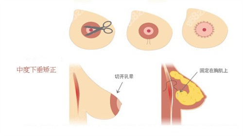 乳房悬吊法矫正下垂