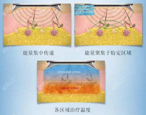 miradry清新微波治疗的原理