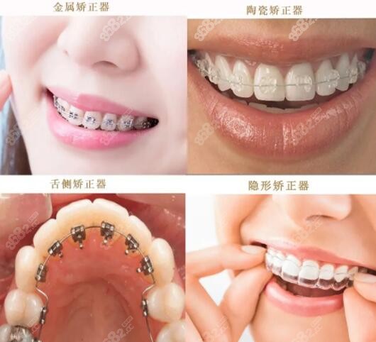 泉州柏德口腔医院整牙优势