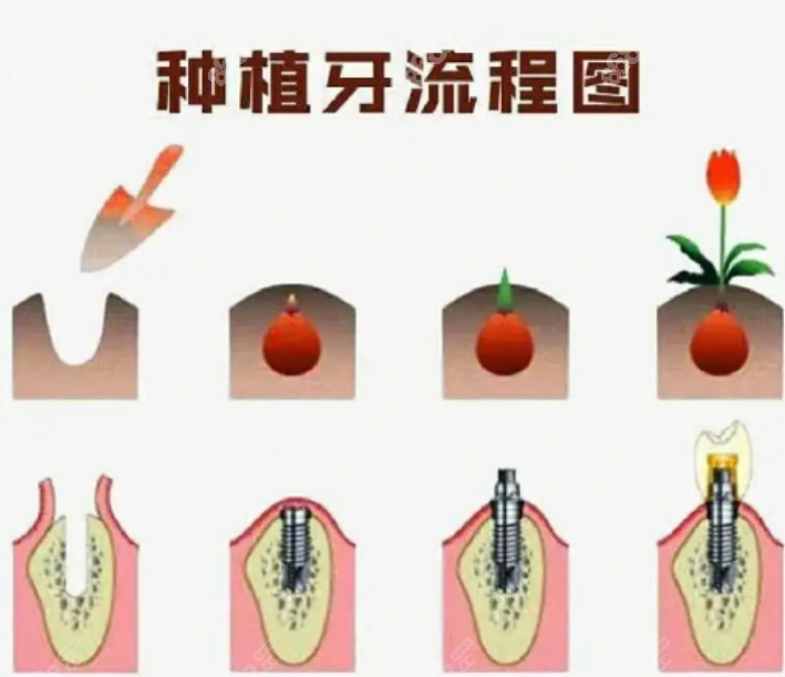 种植牙手术 种植牙手术