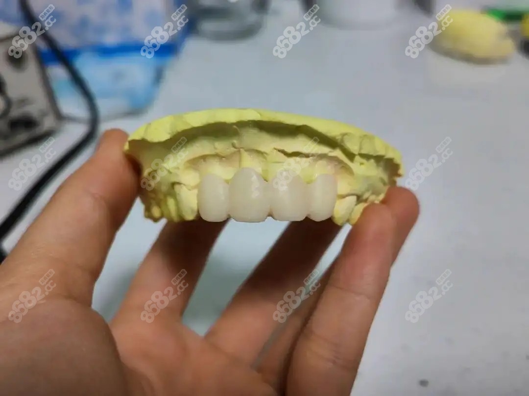 什么是正畸牙模？3d打印正畸牙模怎么做呢？ - 哔哩哔哩