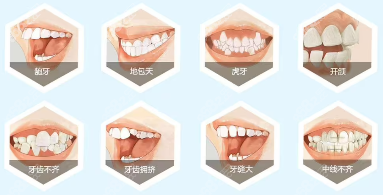 成人牙齿矫正的费用是8000元起8682.cc