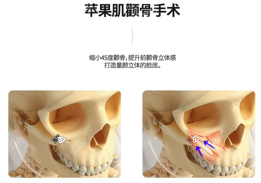 林宗宇颧骨缩小手术做的好，推荐技术：苹果肌颧骨手术