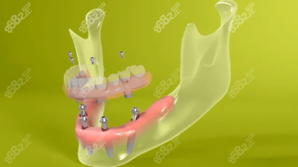 即刻负重种植牙技术适用症状 即刻负重种植牙技术适用症状
