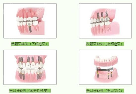 泉州柏德口腔医院种牙优势m.8682.cc