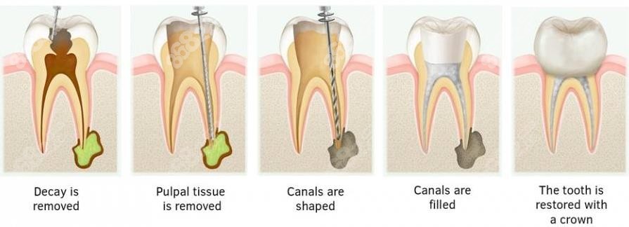 <!--<i data=20240705-sp></i>-->根管治疗费用加牙冠多少钱