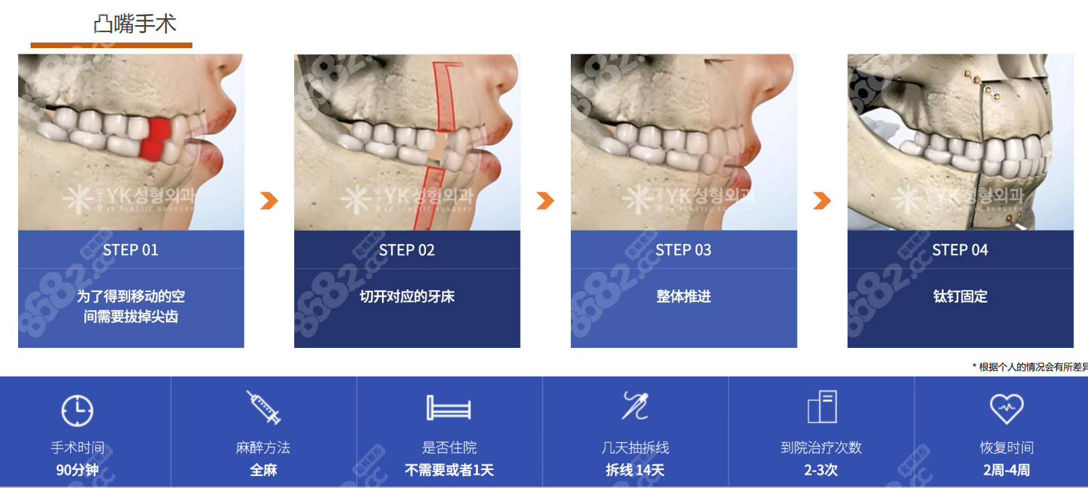 金勇圭凸嘴手術(shù)怎么樣