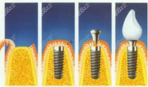 种植牙手术 种植牙手术