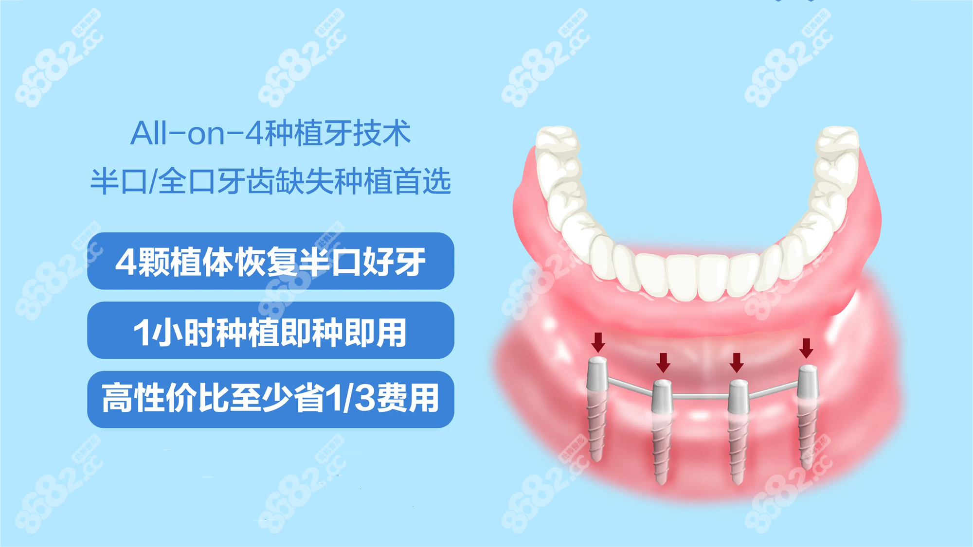 登特口腔做半口种植牙过程8682.cc