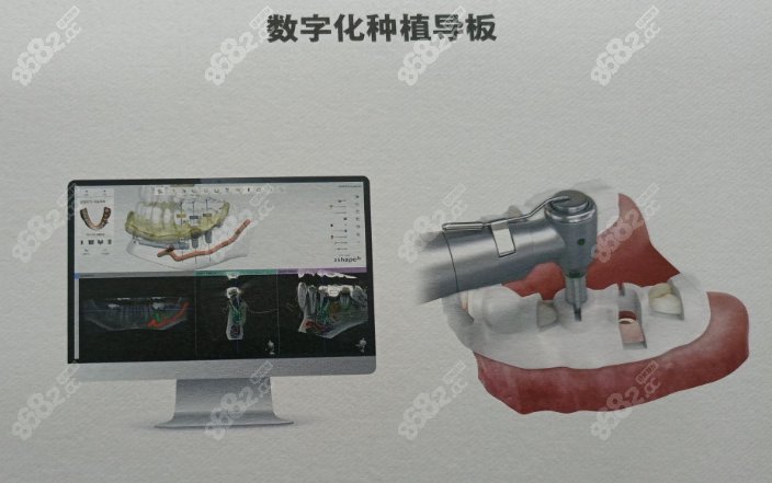 洛阳牙大夫口腔医院种植牙技术优势