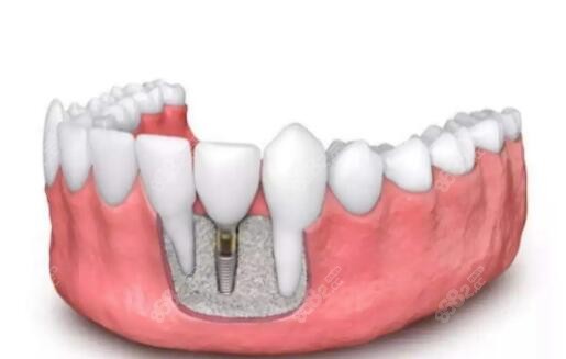 杭数口腔做种植牙好吗 杭数口腔做种植牙好吗