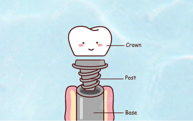口腔种植牙怎么样