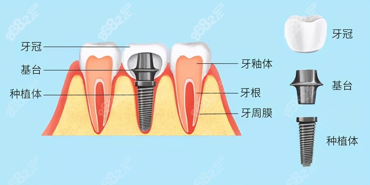 宁德牙院长口腔种植牙技术8682.cc