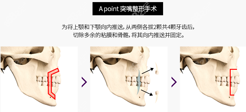 韓國夢想正頜手術(shù)圖示