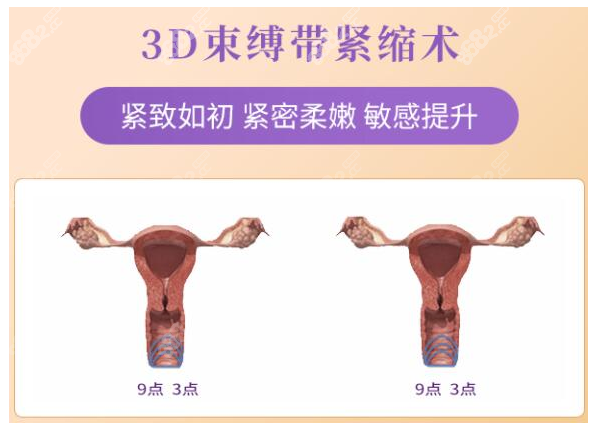 3d生物束带紧缩术后多久可以同房