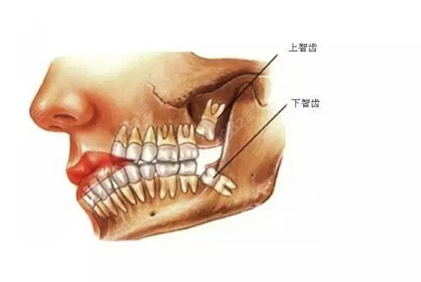 上下颌智齿的图