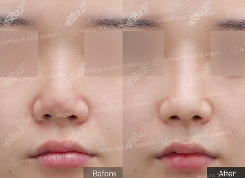 韩国宇博斯整形鼻修复实例 韩国宇博斯整形鼻修复实例