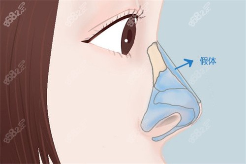 假体隆鼻结构展示图