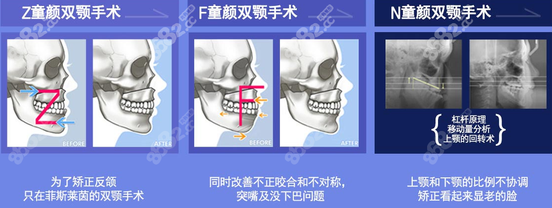 韓國菲斯萊茵醫(yī)院正頜技術(shù)