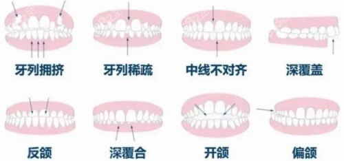 各种牙齿畸形问题示意图