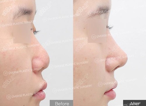 宇博斯整形鼻修复好 宇博斯整形鼻修复好
