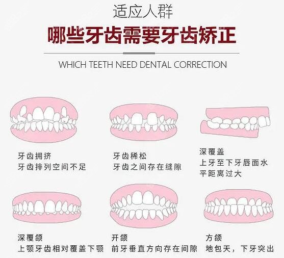 深圳罗湖区成人牙齿矫正哪家好