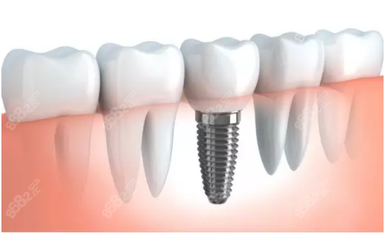 北京亿阳口腔种植牙怎么样