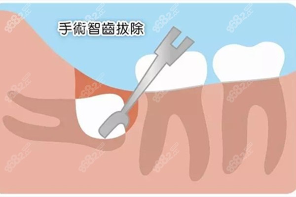 手术智齿拔除www.8682.cc