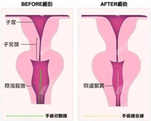 八爪鱼紧缩术价格是多少？