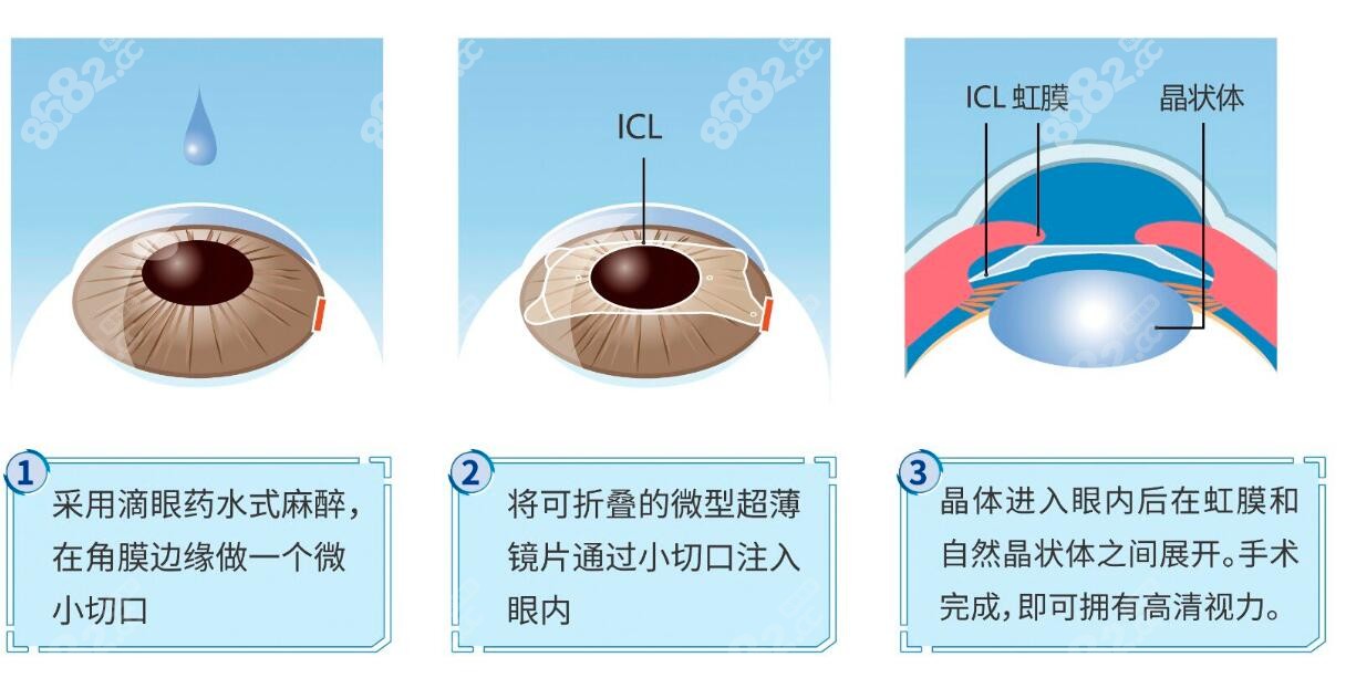 晶体矫正近视眼手术