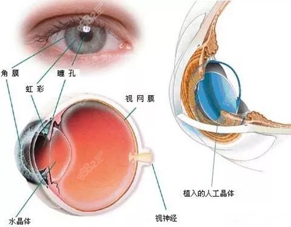 眼睛近视1000度可做晶体植入手术8682.cc