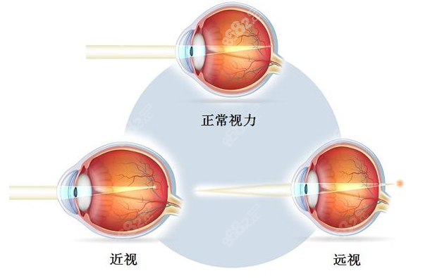 石家庄近视眼激光手术价格9800元起