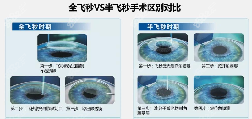 半飞秒手术和全飞秒手术的区别