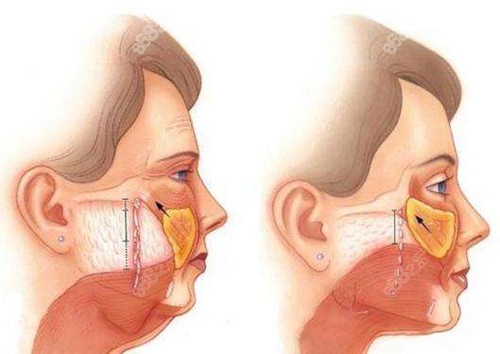 psv面部提升手术切口在哪里www.8682.cc