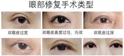 朱武根医生做双眼皮好吗？