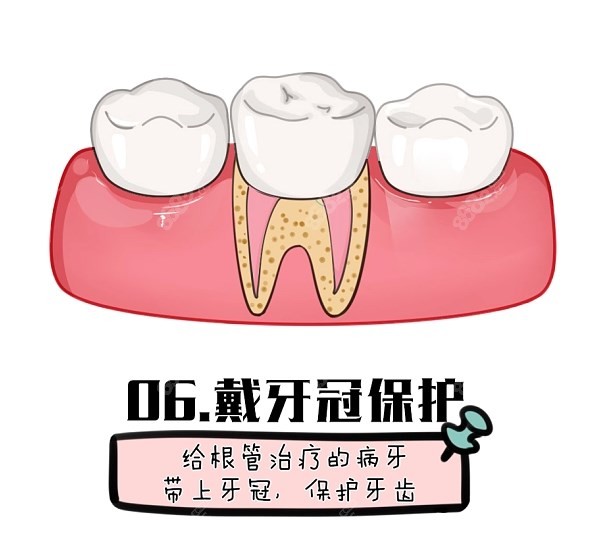 根管治疗带牙冠