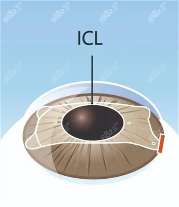 ICL晶体植入的优势和价格