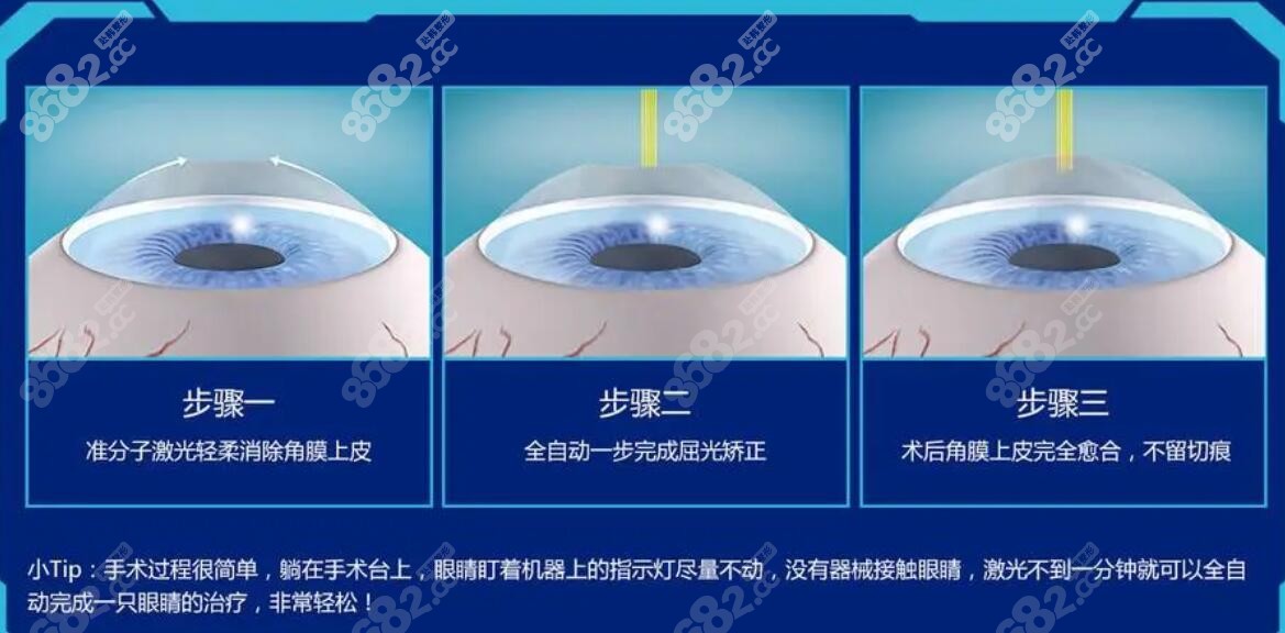 全激光近视眼矫正价格更便宜