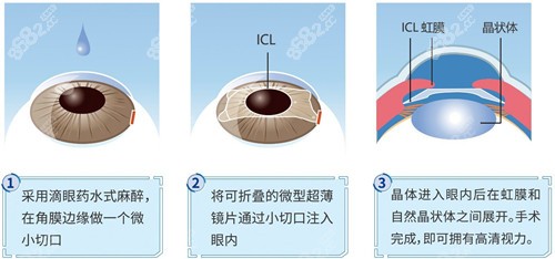 新疆地区近视眼手术费用明细