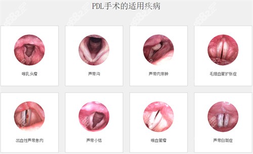 声带女性化整形手术多少钱？