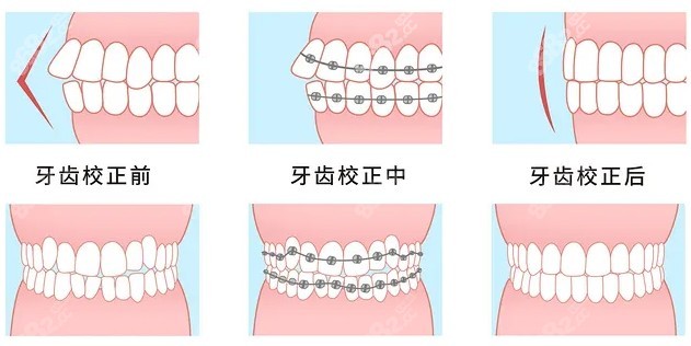 百色矫正牙齿哪家好