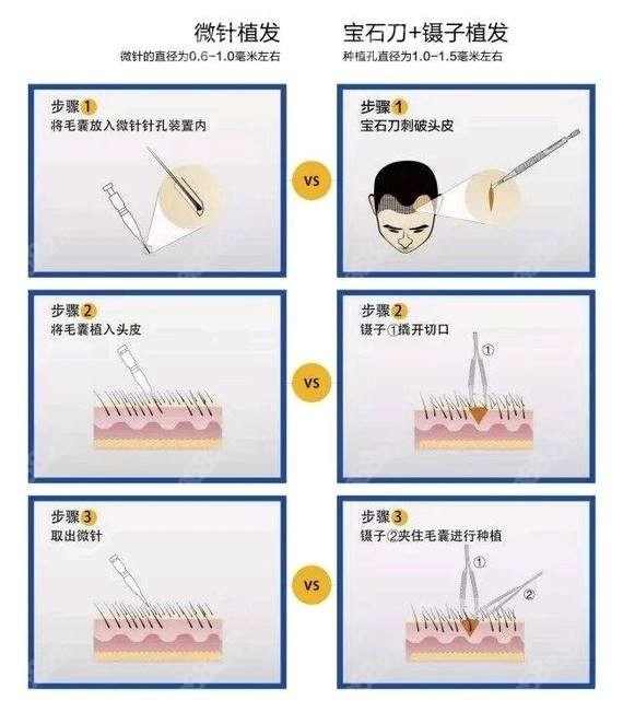 2200毛囊发际线植发什么价格